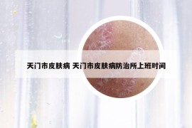 天門(mén)市皮膚病 天門(mén)市皮膚病防治所上班時(shí)間