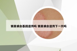 銀屑病會(huì)基因遺傳嗎 銀屑病會(huì)遺傳下一代嗎