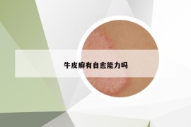 牛皮癬有自愈能力嗎