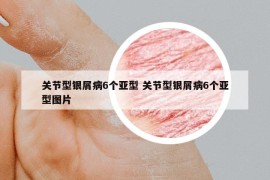 關(guān)節(jié)型銀屑病6個亞型 關(guān)節(jié)型銀屑病6個亞型圖片