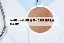 36歲第一次的銀屑病 第一次的銀屑病全身都是很重