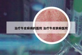 治療牛皮癬病的醫(yī)院 治療牛皮膚癬醫(yī)院