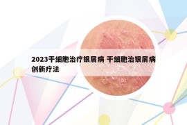 2023干細(xì)胞治療銀屑病 干細(xì)胞治銀屑病創(chuàng)新療法