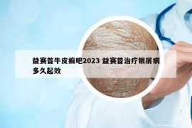 益賽普牛皮癬吧2023 益賽普治療銀屑病多久起效