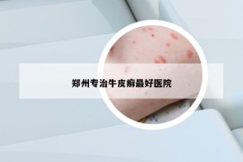 鄭州專治牛皮癬最好醫(yī)院