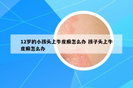 12歲的小孩頭上牛皮癬怎么辦 孩子頭上牛皮癬怎么辦