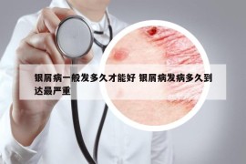 銀屑病一般發(fā)多久才能好 銀屑病發(fā)病多久到達(dá)最嚴(yán)重