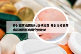 開封銀屑病醫(yī)院to選楊淑蓮 開封治療銀屑病鄭州銀屑病研究院地址