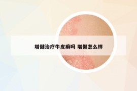 增健治療牛皮癬嗎 增健怎么樣