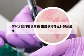 何時才能打敗銀屑病 銀屑病打什么針好的最快