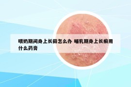 喂奶期間身上長蘚怎么辦 哺乳期身上長癬用什么藥膏