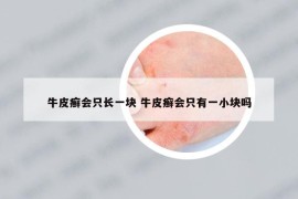 牛皮癬會只長一塊 牛皮癬會只有一小塊嗎