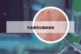 牛皮癬可以提前退休