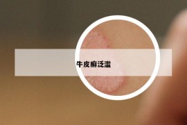 牛皮癬泛濫