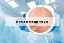 瓜子牛皮癬 牛皮屑能吃瓜子嗎
