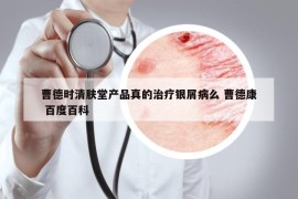 曹德時清膚堂產(chǎn)品真的治療銀屑病么 曹德康 百度百科
