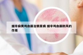 細辛麻黃雞血藤治銀屑病 細辛雞血藤防風的作用