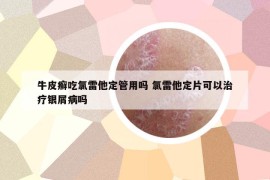 牛皮癬吃氯雷他定管用嗎 氯雷他定片可以治療銀屑病嗎