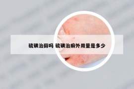 硫磺治蘚嗎 硫磺治癬外用量是多少