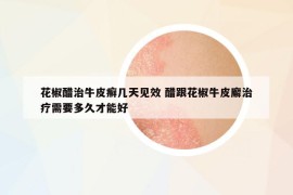 花椒醋治牛皮癬幾天見效 醋跟花椒牛皮廨治療需要多久才能好
