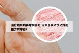 治療銀屑病要命的偏方 治銀屑病又快又好的偏方有哪些?