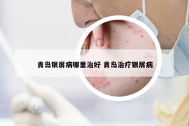 青島銀屑病哪里治好 青島治療銀屑病