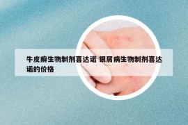 牛皮癬生物制劑喜達(dá)諾 銀屑病生物制劑喜達(dá)諾的價(jià)格