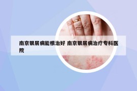 南京銀屑病能根治好 南京銀屑病治療?？漆t(yī)院