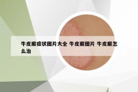 牛皮廨癥狀圖片大全 牛皮廨圖片 牛皮廨怎么治