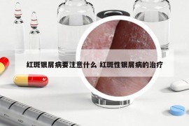 紅斑銀屑病要注意什么 紅斑性銀屑病的治療