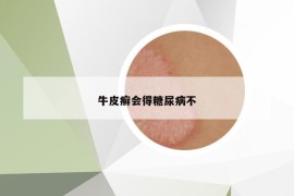 牛皮癬會得糖尿病不
