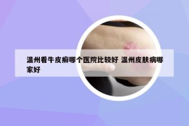 溫州看牛皮癬哪個(gè)醫(yī)院比較好 溫州皮膚病哪家好