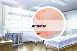 尿療牛皮癬