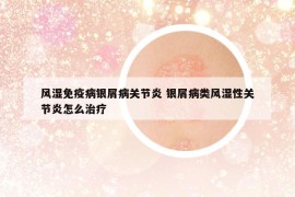 風(fēng)濕免疫病銀屑病關(guān)節(jié)炎 銀屑病類風(fēng)濕性關(guān)節(jié)炎怎么治療