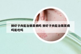 鮮蝦子肉能治銀屑病嗎 鮮蝦子肉能治銀屑病嗎能吃嗎