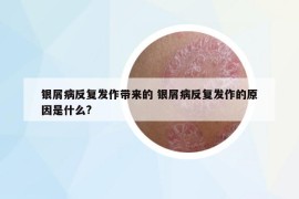 銀屑病反復(fù)發(fā)作帶來(lái)的 銀屑病反復(fù)發(fā)作的原因是什么?