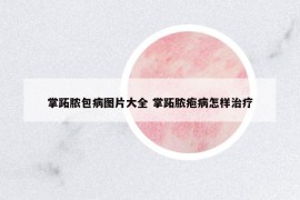 掌跖膿包病圖片大全 掌跖膿皰病怎樣治療