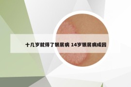 十幾歲就得了銀屑病 14歲銀屑病成因