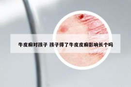 牛皮癬對孩子 孩子得了牛皮皮癬影響長個嗎