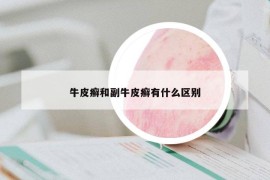 牛皮癬和副牛皮癬有什么區(qū)別