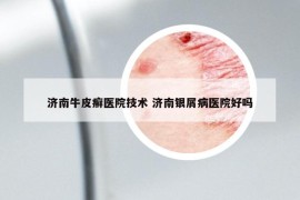 濟南牛皮癬醫(yī)院技術 濟南銀屑病醫(yī)院好嗎
