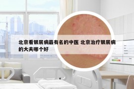 北京看銀屑病最有名的中醫(yī) 北京治療銀屑病的大夫哪個(gè)好