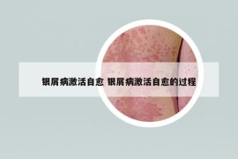 銀屑病激活自愈 銀屑病激活自愈的過(guò)程
