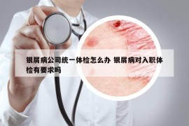 銀屑病公司統(tǒng)一體檢怎么辦 銀屑病對(duì)入職體檢有要求嗎