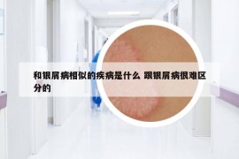 和銀屑病相似的疾病是什么 跟銀屑病很難區(qū)分的