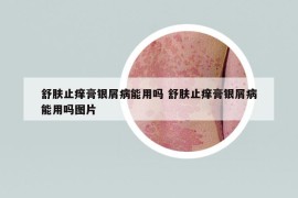 舒膚止癢膏銀屑病能用嗎 舒膚止癢膏銀屑病能用嗎圖片