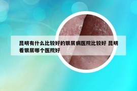 昆明有什么比較好的銀屑病醫(yī)院比較好 昆明看銀屑哪個醫(yī)院好