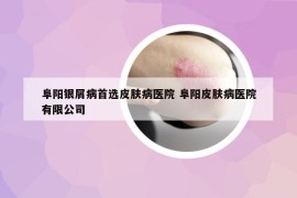 阜陽銀屑病首選皮膚病醫(yī)院 阜陽皮膚病醫(yī)院有限公司
