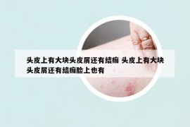 頭皮上有大塊頭皮屑還有結(jié)痂 頭皮上有大塊頭皮屑還有結(jié)痂臉上也有