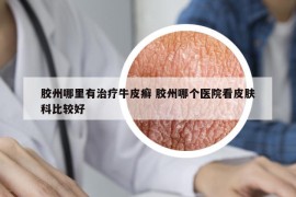 膠州哪里有治療牛皮癬 膠州哪個醫(yī)院看皮膚科比較好